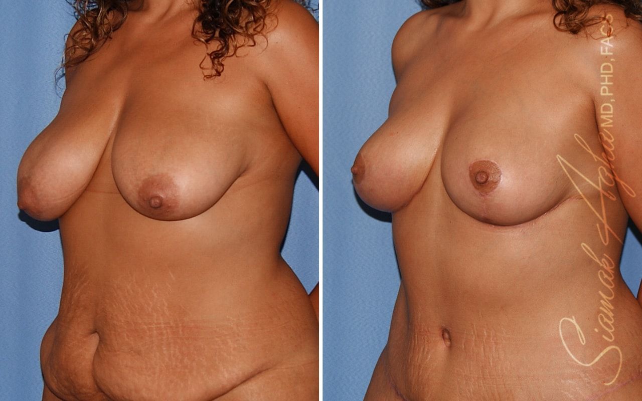 Breast Lift Before & After