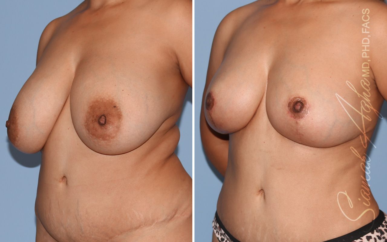 Breast Lift Before & After