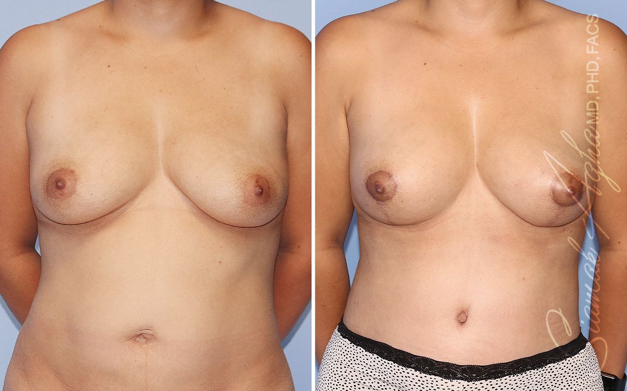 Breast Lift Before & After