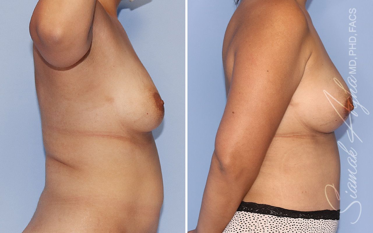 Breast Lift Before & After