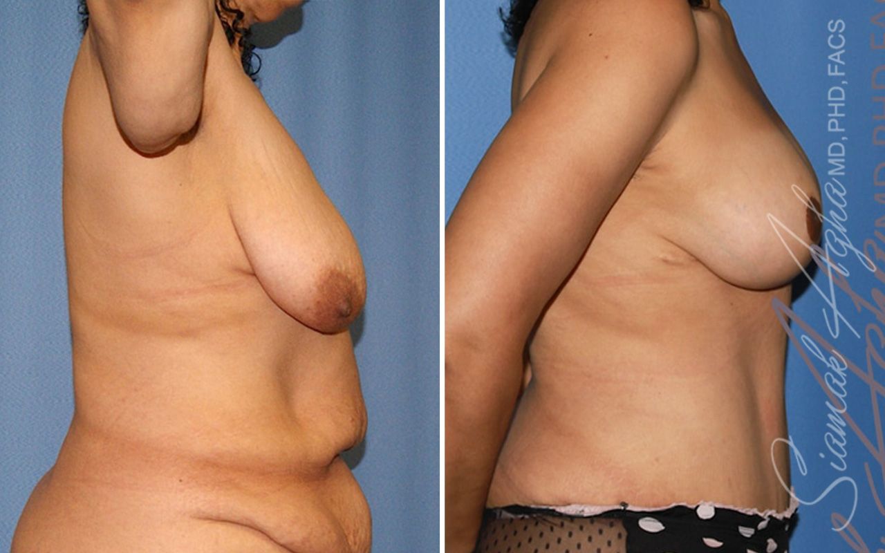 Breast Lift Before & After