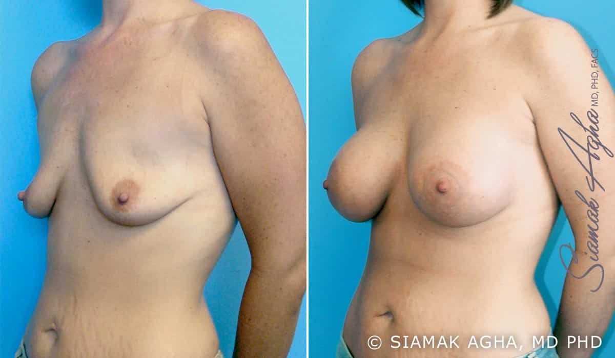 Breast Lift With Augmentation Before & After