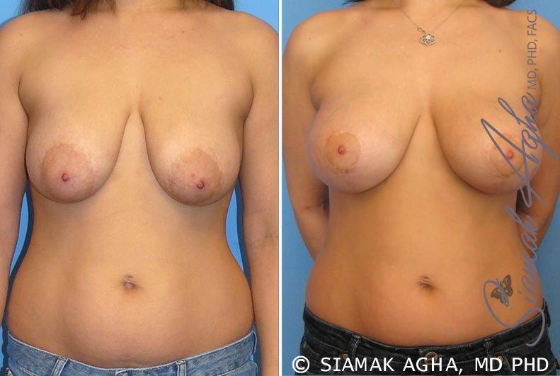 Breast Lift With Augmentation Before & After