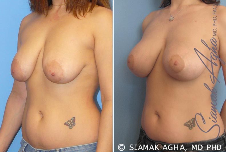 Breast Lift With Augmentation Before & After
