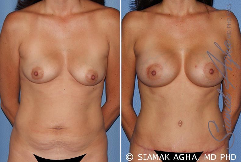 Breast Lift With Augmentation Before & After