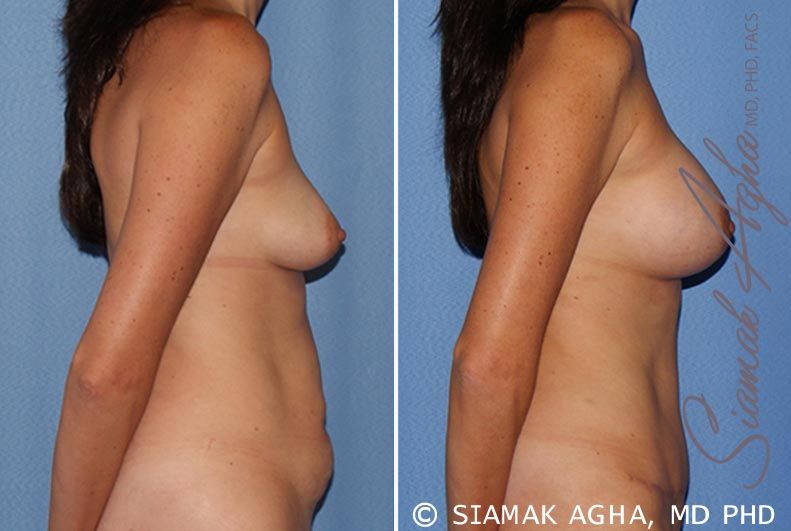 Breast Lift With Augmentation Before & After