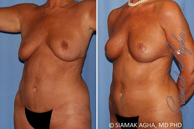 Breast Lift With Augmentation Before & After