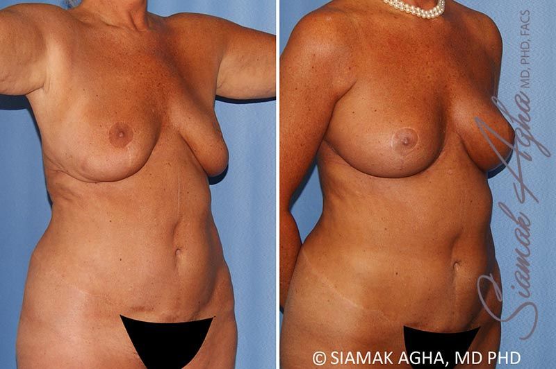Breast Lift With Augmentation Before & After