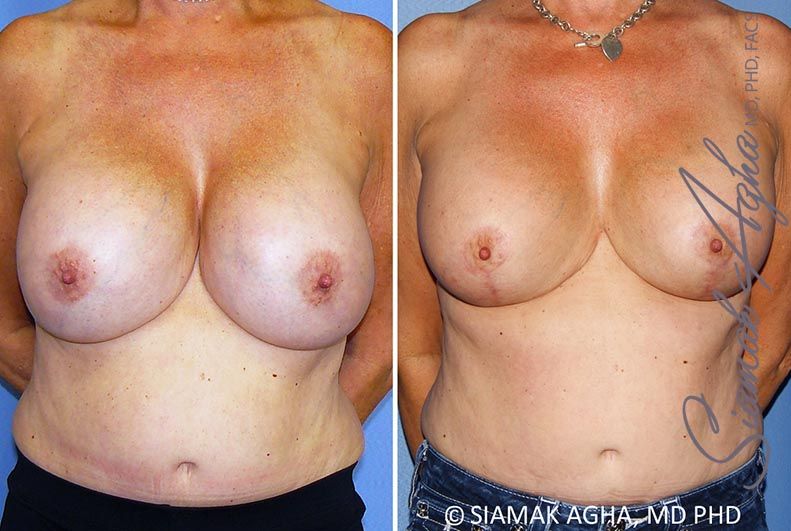 Breast Lift With Augmentation Before & After