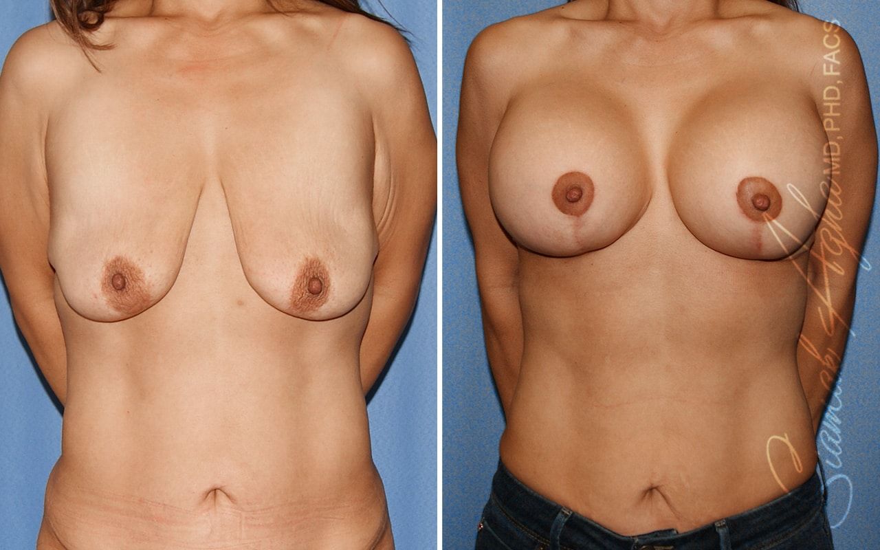Breast Lift With Augmentation Before & After
