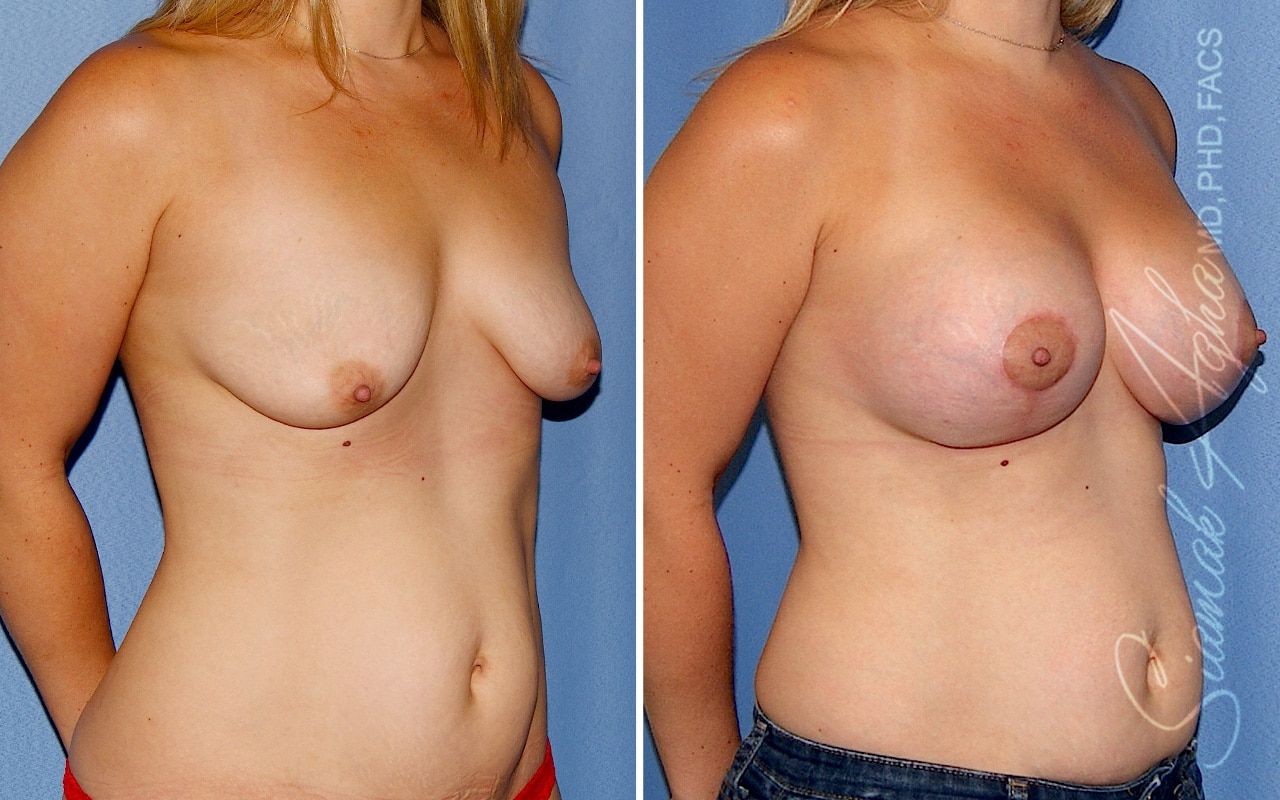 Breast Lift With Augmentation Before & After