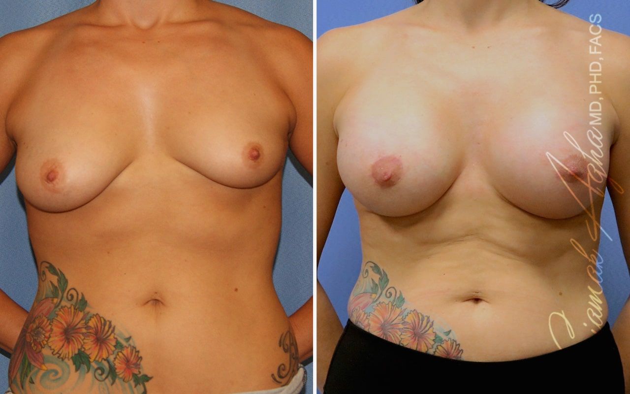 Breast Lift With Augmentation Before & After