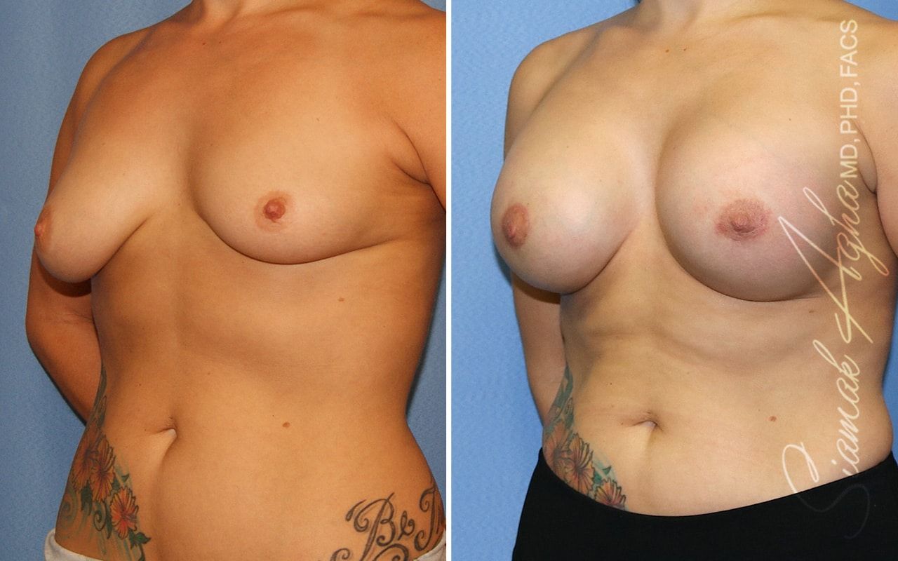 Breast Lift With Augmentation Before & After