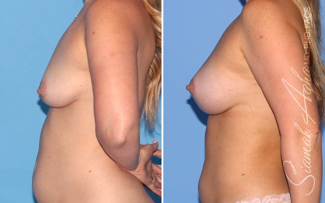 Breast Lift With Augmentation Before & After