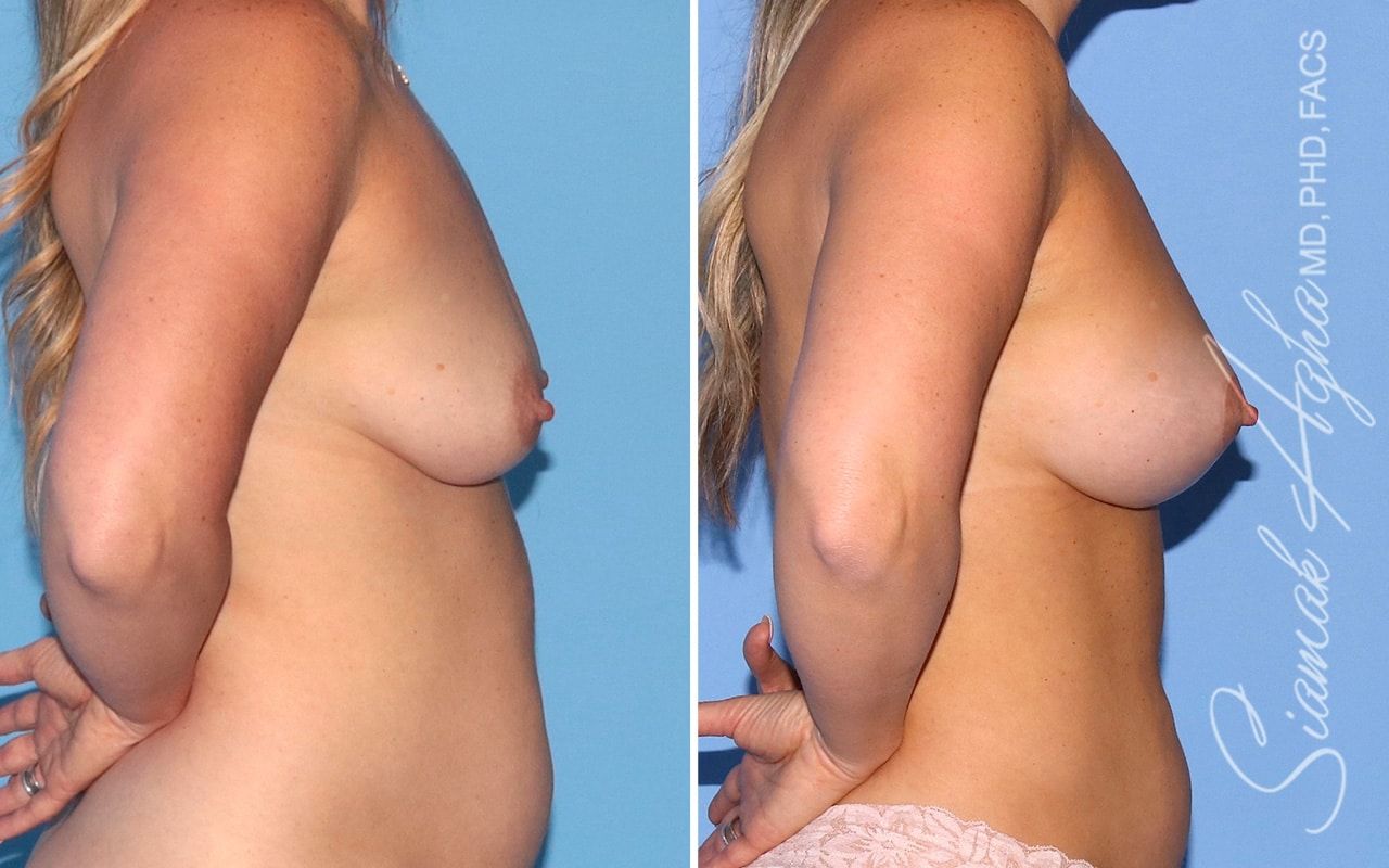 Breast Lift With Augmentation Before & After