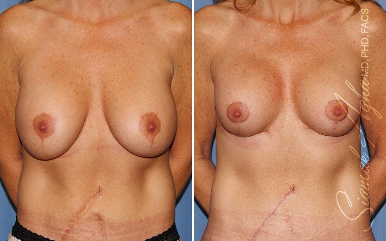 Breast Lift With Augmentation Before & After