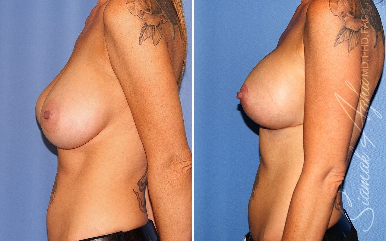 Breast Lift With Augmentation Before & After