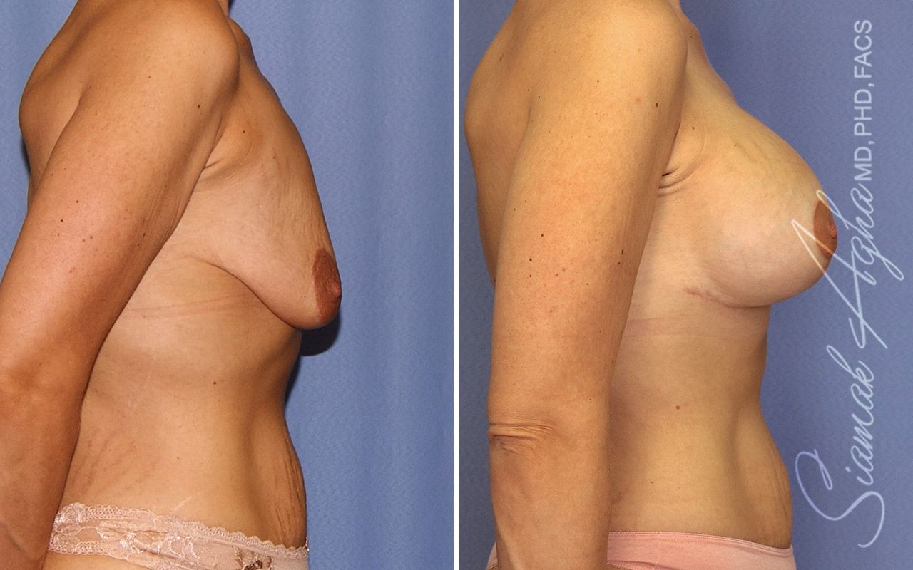 Breast Lift With Augmentation Before & After