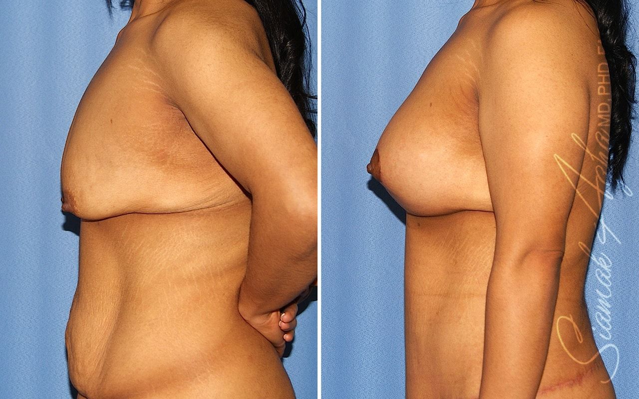 Breast Lift With Augmentation Before & After