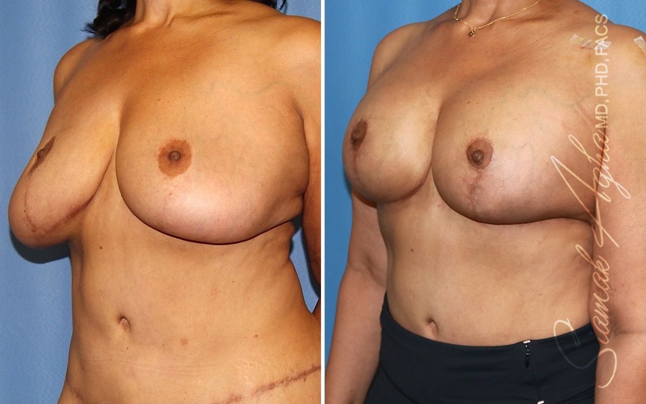 Breast Lift With Augmentation Before & After