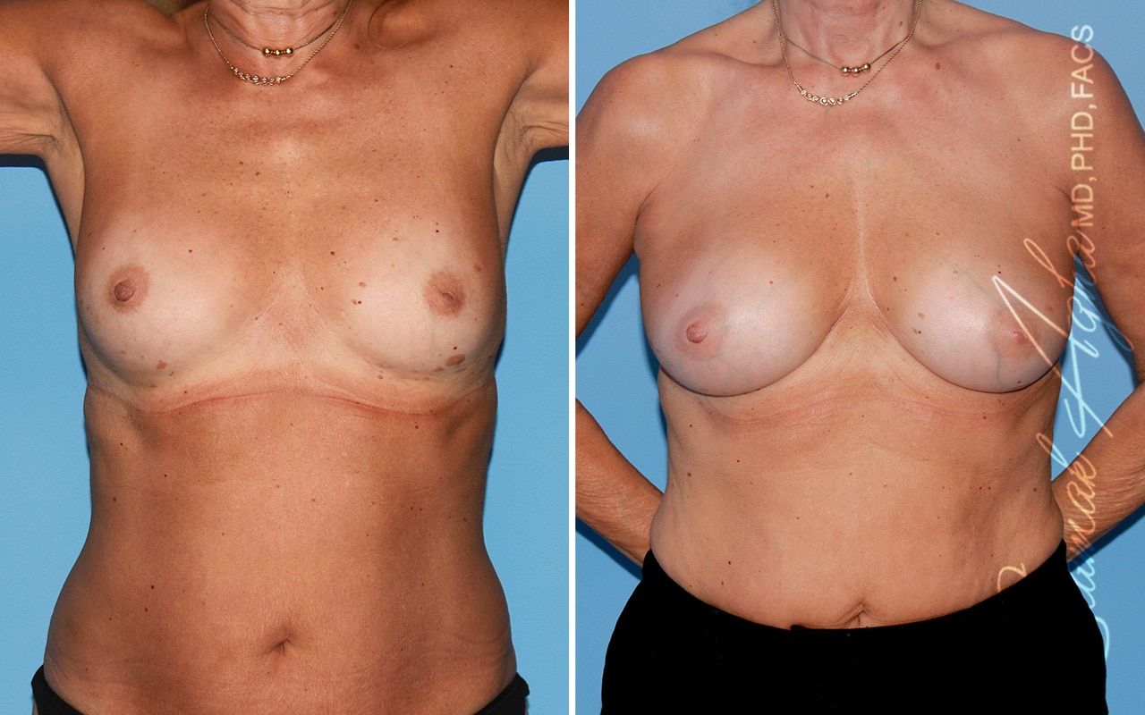 Breast Fat Transfer Before & After