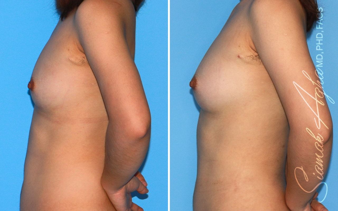 Breast Fat Transfer Before & After