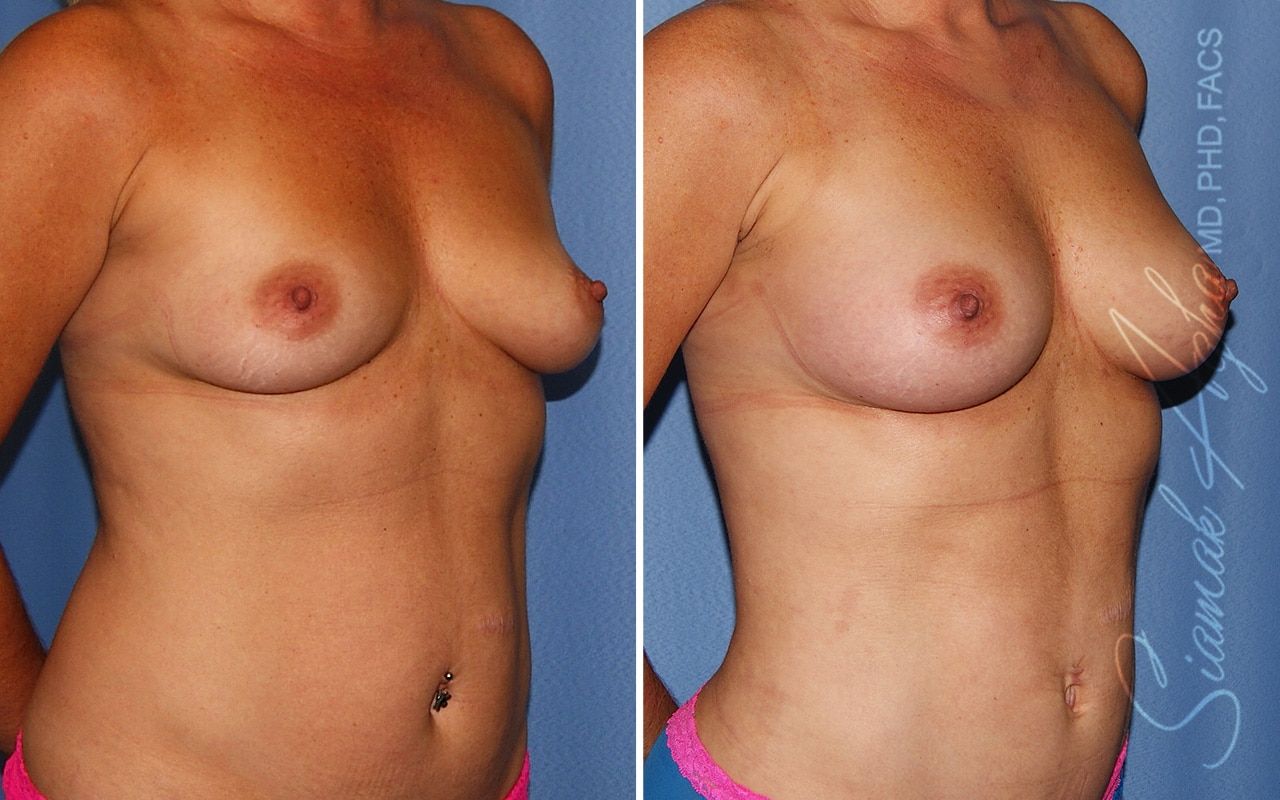 Breast Fat Transfer Before & After