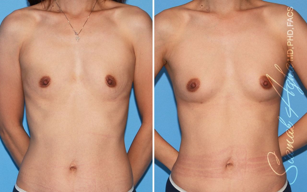 Breast Fat Transfer Before & After