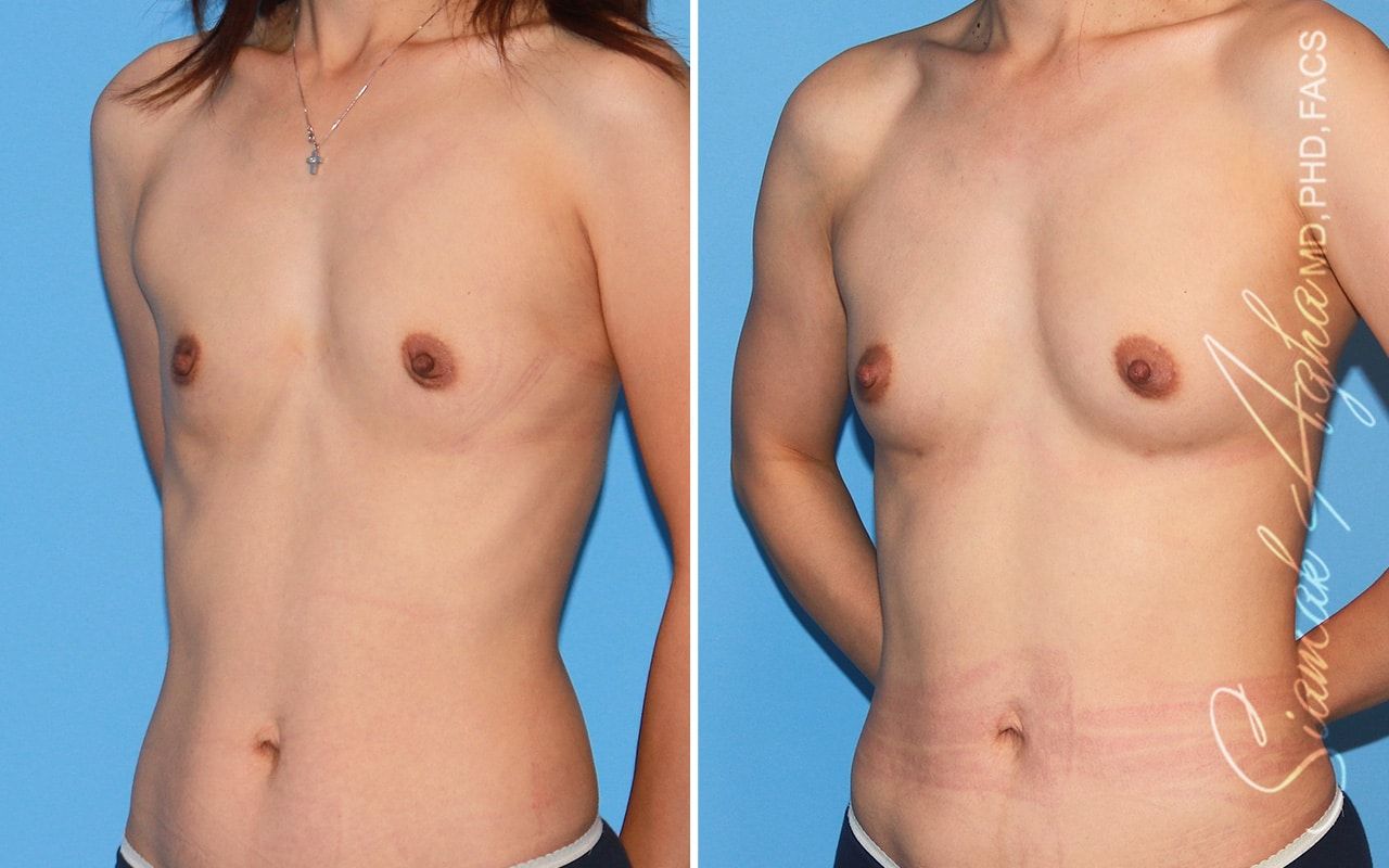 Breast Fat Transfer Before & After