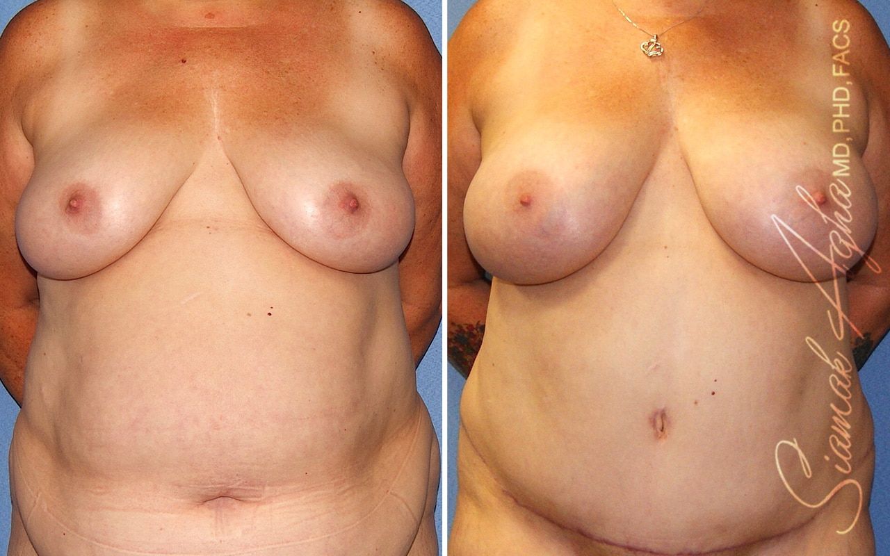 Breast Fat Transfer Before & After