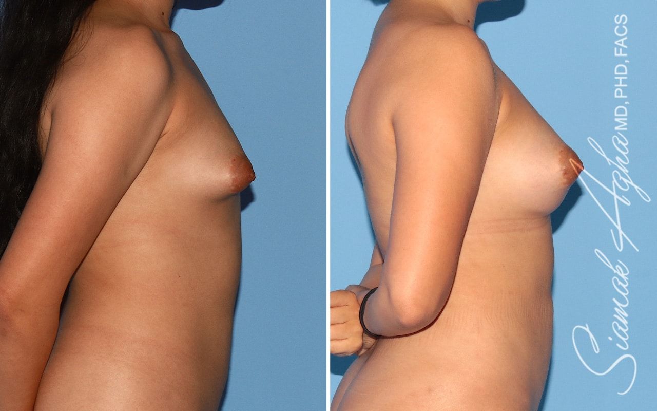 Breast Fat Transfer Before & After