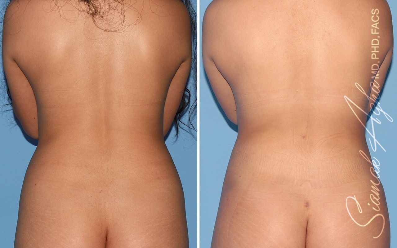 Breast Fat Transfer Before & After