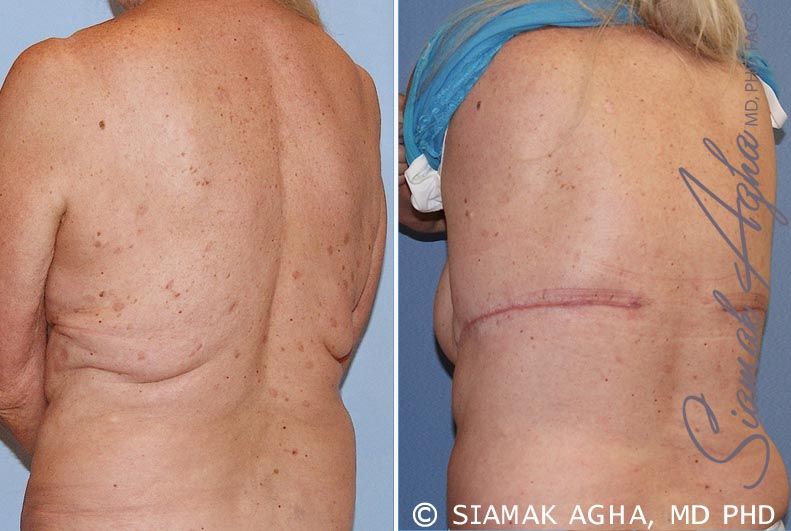 Upper Body Lift Before & After