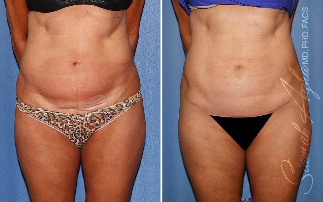 Mini Tummy Tuck Before & After