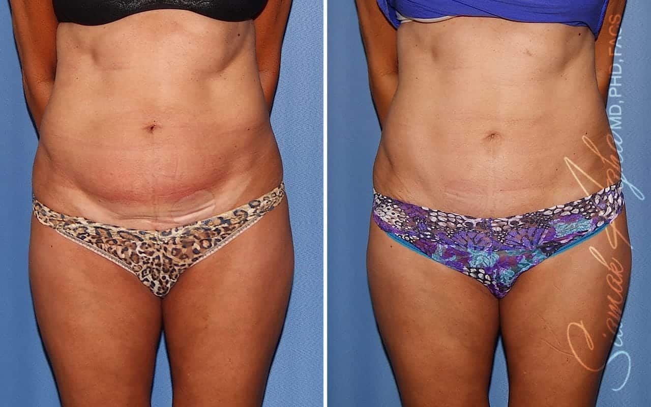 Mini Tummy Tuck Before & After