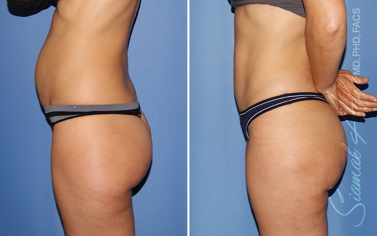 Mini Tummy Tuck Before & After