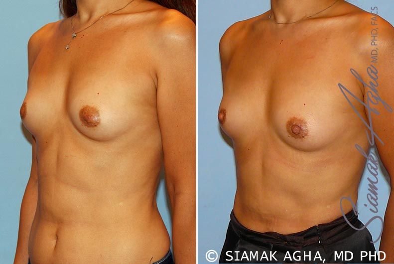 Breast Asymmetry Before & After