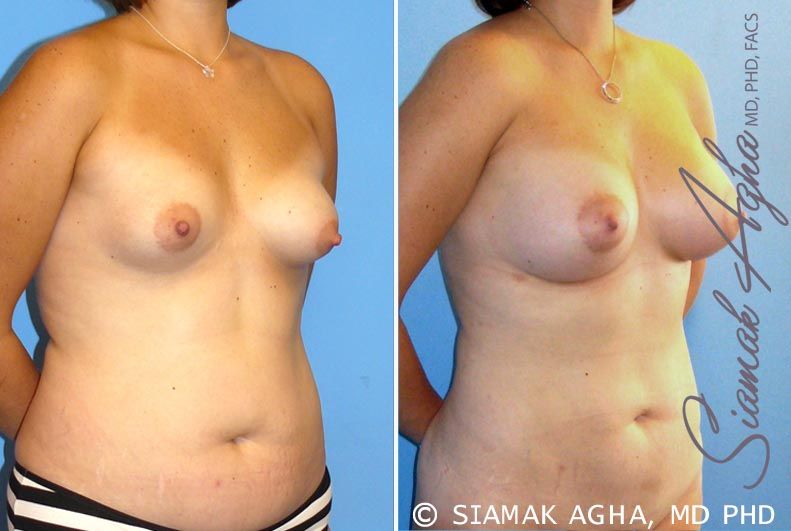 Breast Asymmetry Before & After