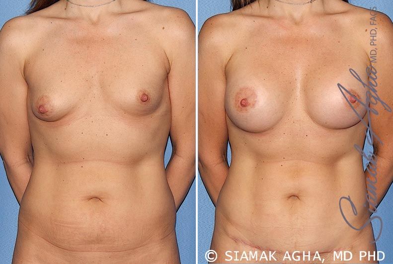 Breast Asymmetry Before & After
