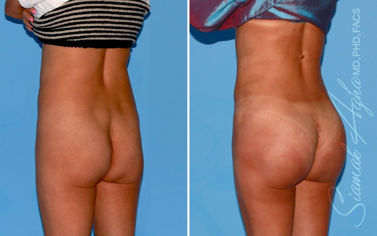 Buttock Implants Before & After