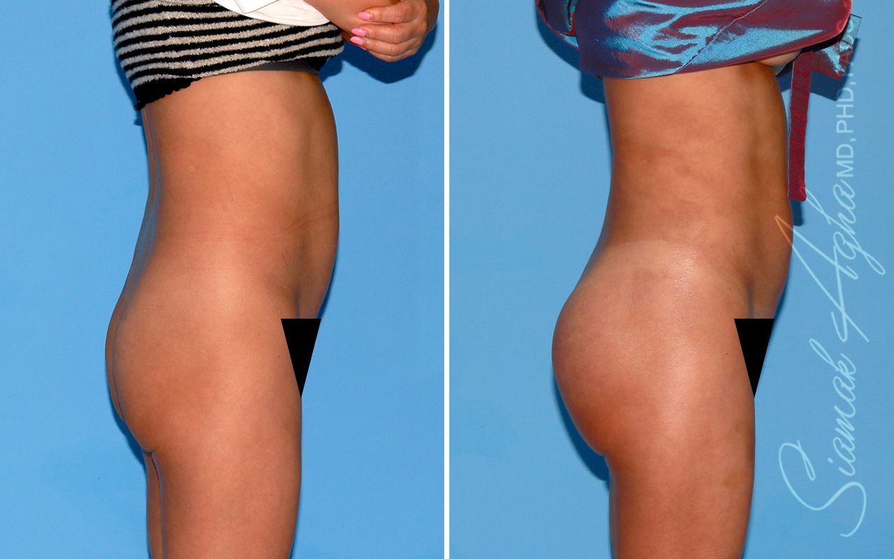 Buttock Implants Before & After