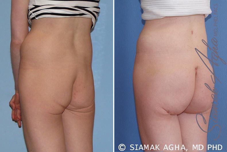 Buttock Implants Before & After