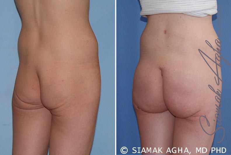 Buttock Implants Before & After