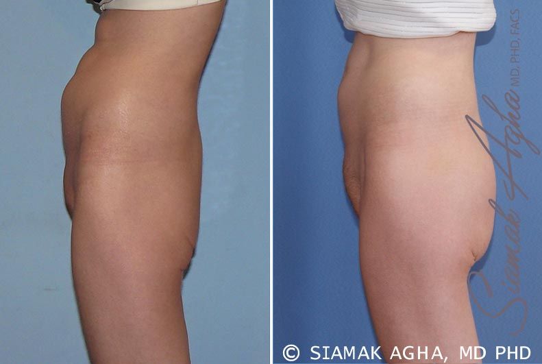 Buttock Implants Before & After