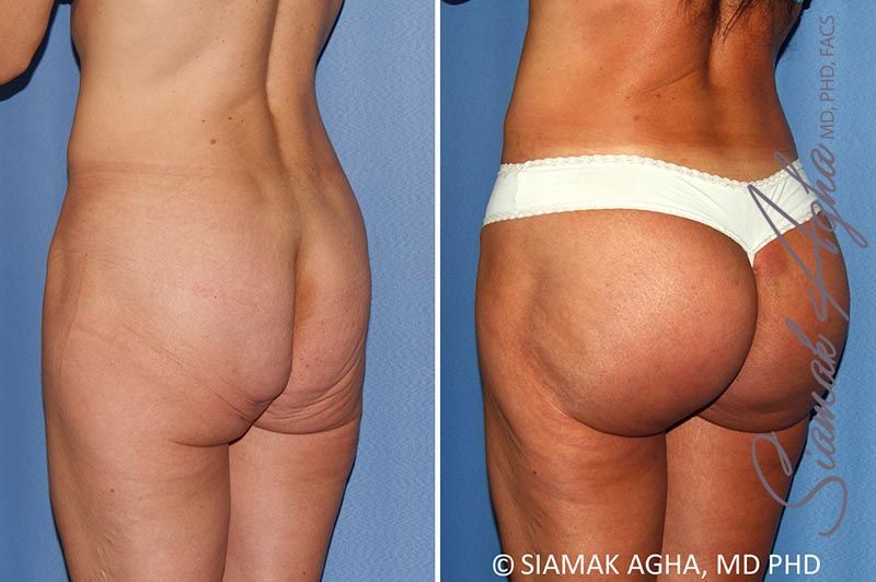 Buttock Implants Before & After