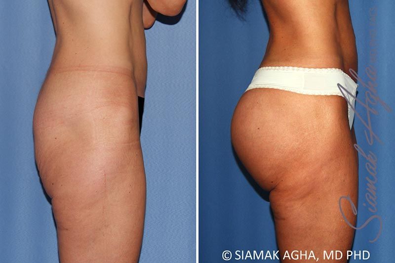 Buttock Implants Before & After